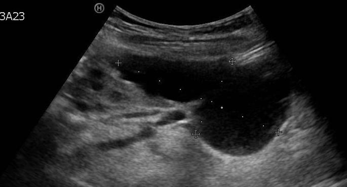 seroma Abscessus