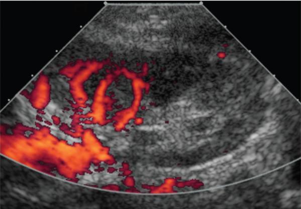 Vascularis szövődmények A graft thrombosis a korai (1.