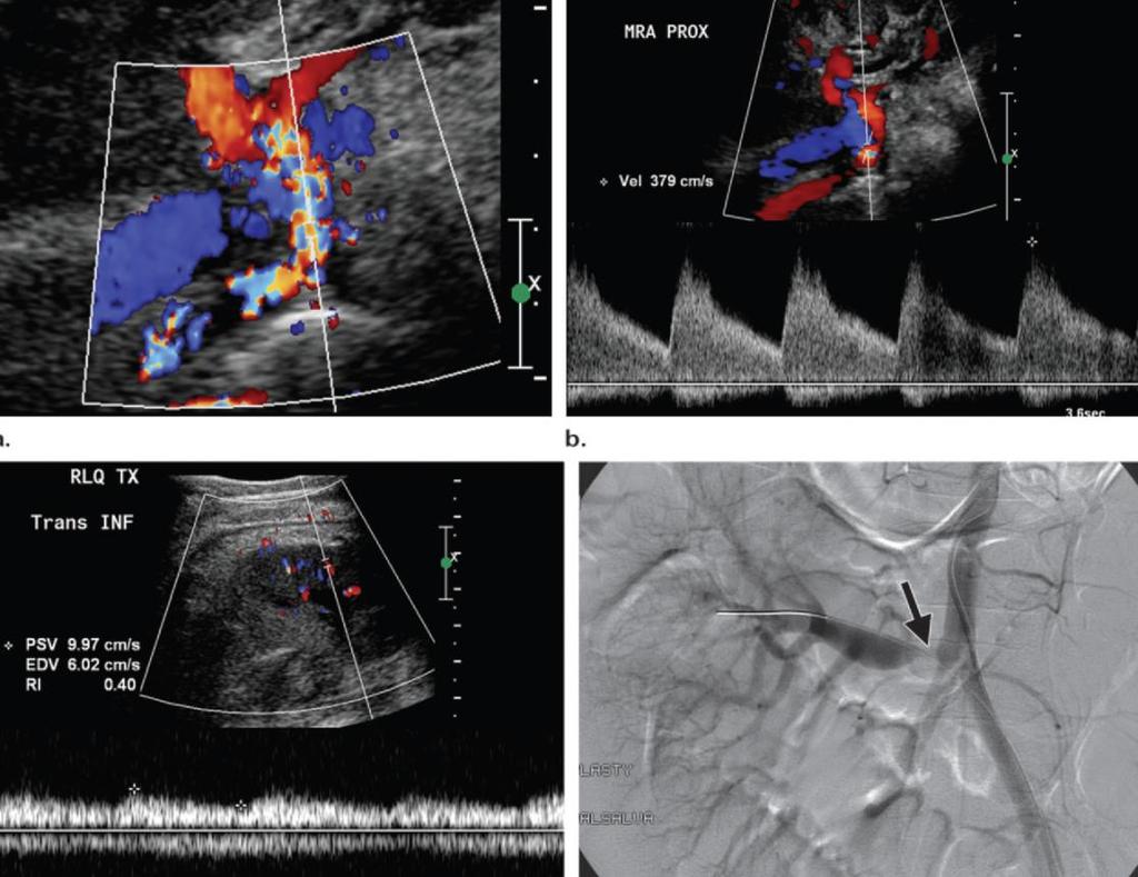 Vascularis szövődmények Arteria renalis stenosis: a szűkületben kiszélesedett spektrum,