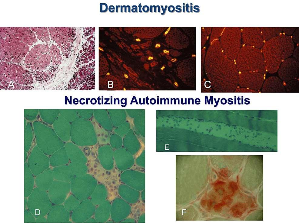 Review: An update on inflammatory and autoimmune myopathies