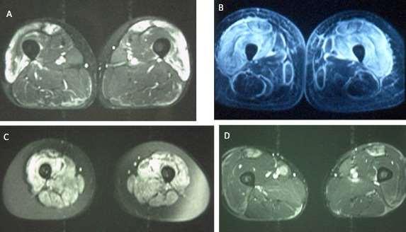 MRI az IIM diagnosisának a felállításában STIR: alkalmas az acut myositisben észlelhető oedema igazolására T1 súlyozás:érzékeny az izom zsirtartalmának a