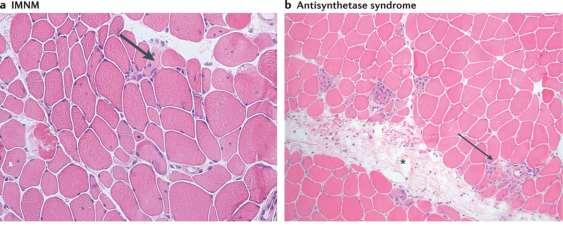 (2018) Treatment in myositis Nat. Rev.