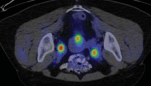 A hibrid PET/CT vagy PET/MR vizsgálatok ötvözik a morfológiai és funkcionális képalkotás elõnyeit. A PET/CT klinikai alkalmazása rutinszerûnek számít Magyarországon (4a-b, 5a, 6.