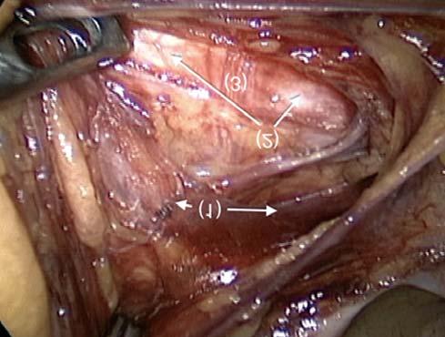 idegkíméletre nem törekvõ mûtétek a sphincterbeidegzések sérülésével vizelet- és székletinkontinenciát okozhatnak (8). 1. ábra. (1) plexus hypogastricus superior (2) bifurcatio aortae (3) a.