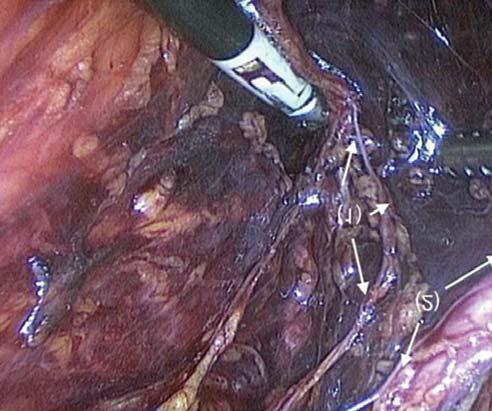 Csibi Noémi és munkatársai gastricus fasciát átfúrva anasztomizálnak a plexus hypogastricus inferiorral a rectum szintjében; míg a vesicalis nn.