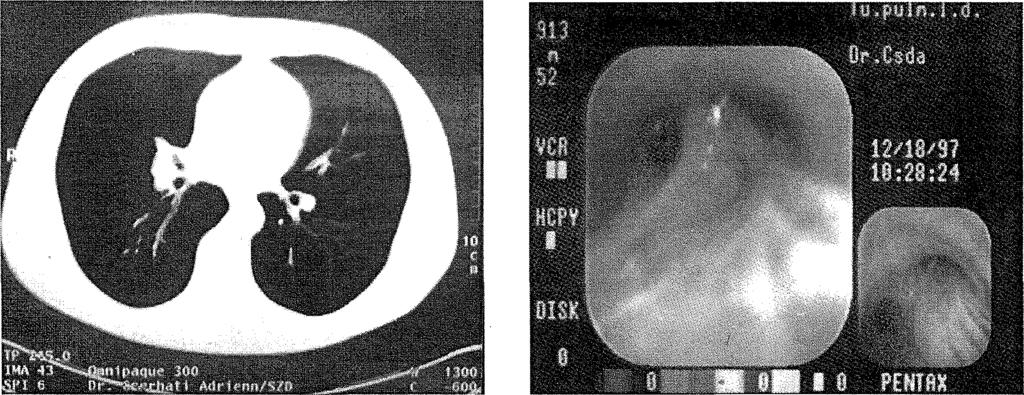 26 6. ábra: Endobronchialis TBC 7 ábra: Endobronchialis TBC tüdőablakos CT képe bronchoscopos képe.