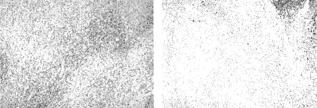 39 17. ábra. CD4(+) T-helper sejtek 18. ábra. CD20(+) B lymphocyták a granuloma belső részén (IH) kevés számban (IH) 8.3.3. HSP70 Ugyan a lymphocyták kvalitatív immunhisztokémiai vizsgálata