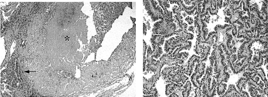 sclerotizáló BAC előfordulása között. A 29. ábra egy korábban kezelt TBC-s beteg tüdejében kialakult bronchioloalveolaris carcinomát mutat.