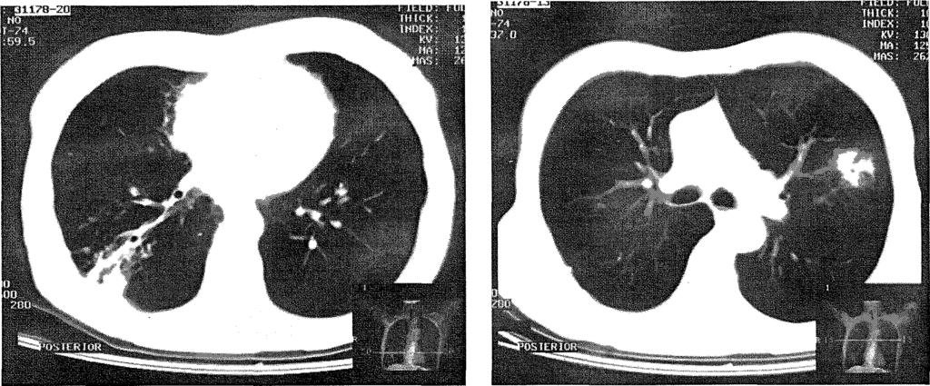 59 i; f: * 29. ábra Korábbi TBC szövődményeként kialakult bronchiectasia (jobb oldalon) és a bronchioloalveloris carcinoma (bal oldalon) 8.4.6.