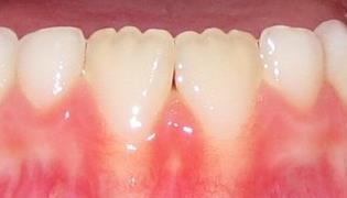 Felső középső metsző dentes incisivi Fa: táplálék