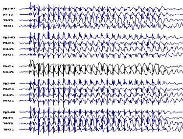 EEG vs