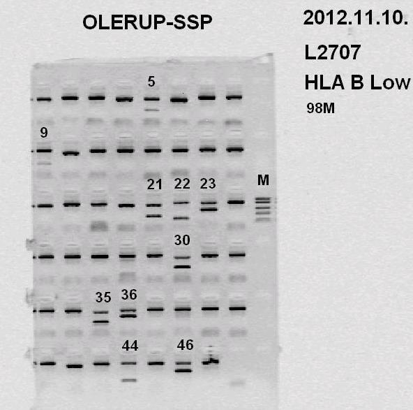 Analízis: agaróz gélelektroforézis; A HLA-típus megállapítása