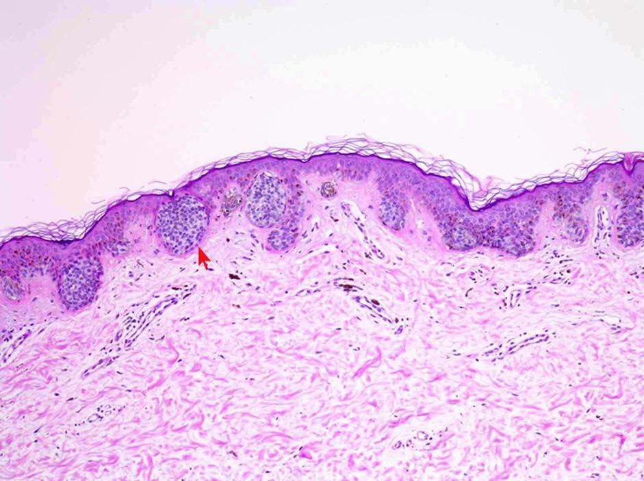 Pigmentált naevus A dermo-epidermalis junctioból indulnak ki.