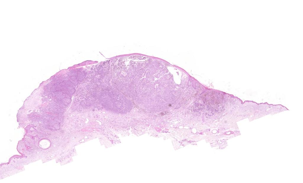 Breslow-féle vastagság: tumort fedő epidermis granularis sejtrétegének és a tumor legmélyebb