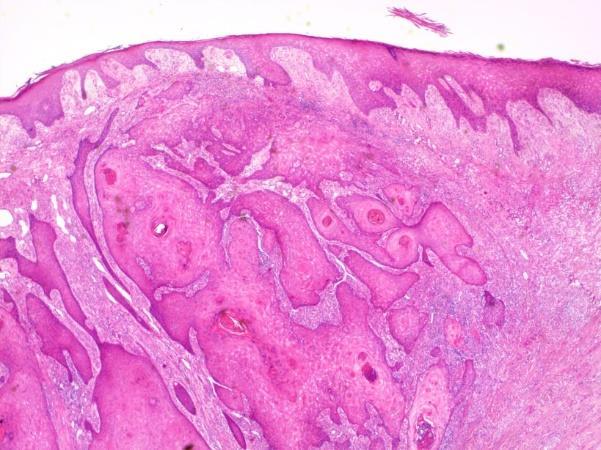 Laphámcarcinoma - szövettan In situ variáns: bőr minden rétegében súlyos atípiát mutató hámsejtek (dysplasticus hám) Hám dezorganizálódik, rétegezettség felbomlik, sejtek orientációja zavart Ha