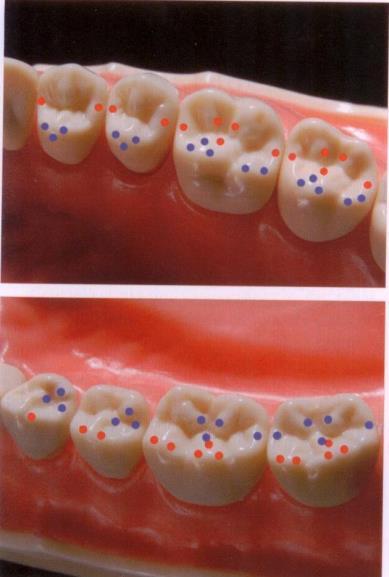 A Gerber-féle mozsár-mozsártörő elmélet szerint a csücsökcsúcsok érintkeznek az antagonista fogak gödreinek aljával. Az E-Körber elmélet szintén csak egy felületen való érintkezést tart megfelelőnek.