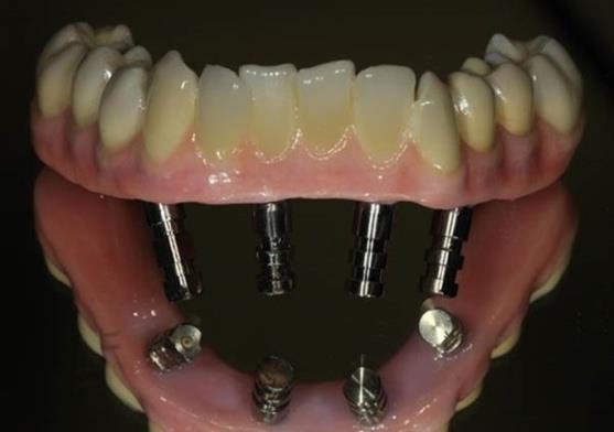 Ezzel szemben a cover dentaure pótlások mindig tartalmaznak protézis alaplemezt, mely az implantális megtámasztás mellett jelentős mértékben közvetíti a rágás terhét a nyálkahártyával fedett
