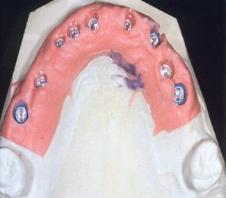 3.12. Az ínymaszk szerepe az implantációs felépítmény elkészítése esetén Az ínymaszk elkészítése: A szekcionálás és a gipszmintán történő gingiva, úgynevezett alácsiszolása, tisztázása során sérül,