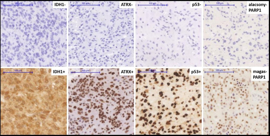 5.2.3 A PARP1 immunhisztokémiai expressziója és az IDH1, ATRX és a p53 markerek közötti összefüggések A bioinformatikai analízis eredményeiből kifolyólag ahol a PARP1 mrns expresszió szignifikáns