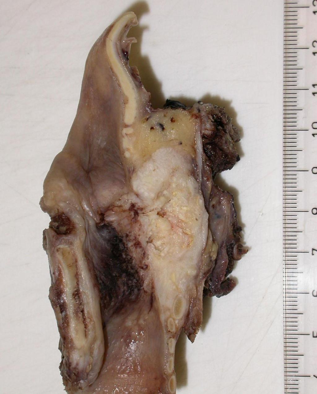 Laphám carcinoma gégében Malignus laphámdaganat -