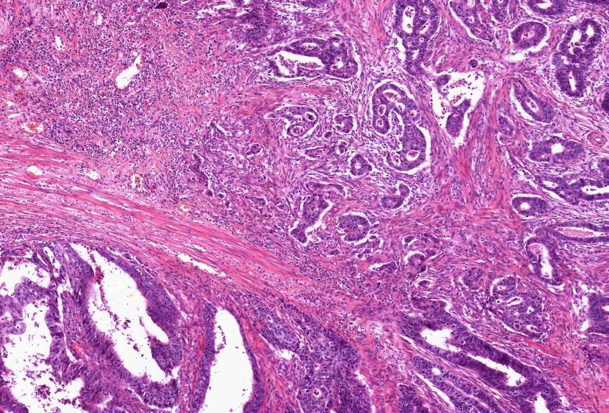 Adenocarcinoma