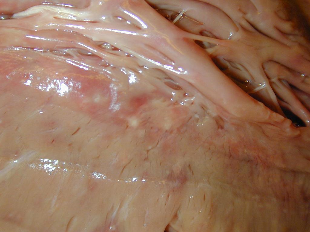 Rheumás myocarditis makroszkópos képe a metszlap foltosságával, aprógócos,