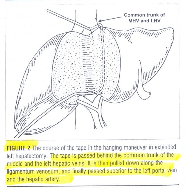 közös törzse alá, majd a máj mögött a bal oldali véna portae és hepatica fölött vezették ki( Fig. 2.