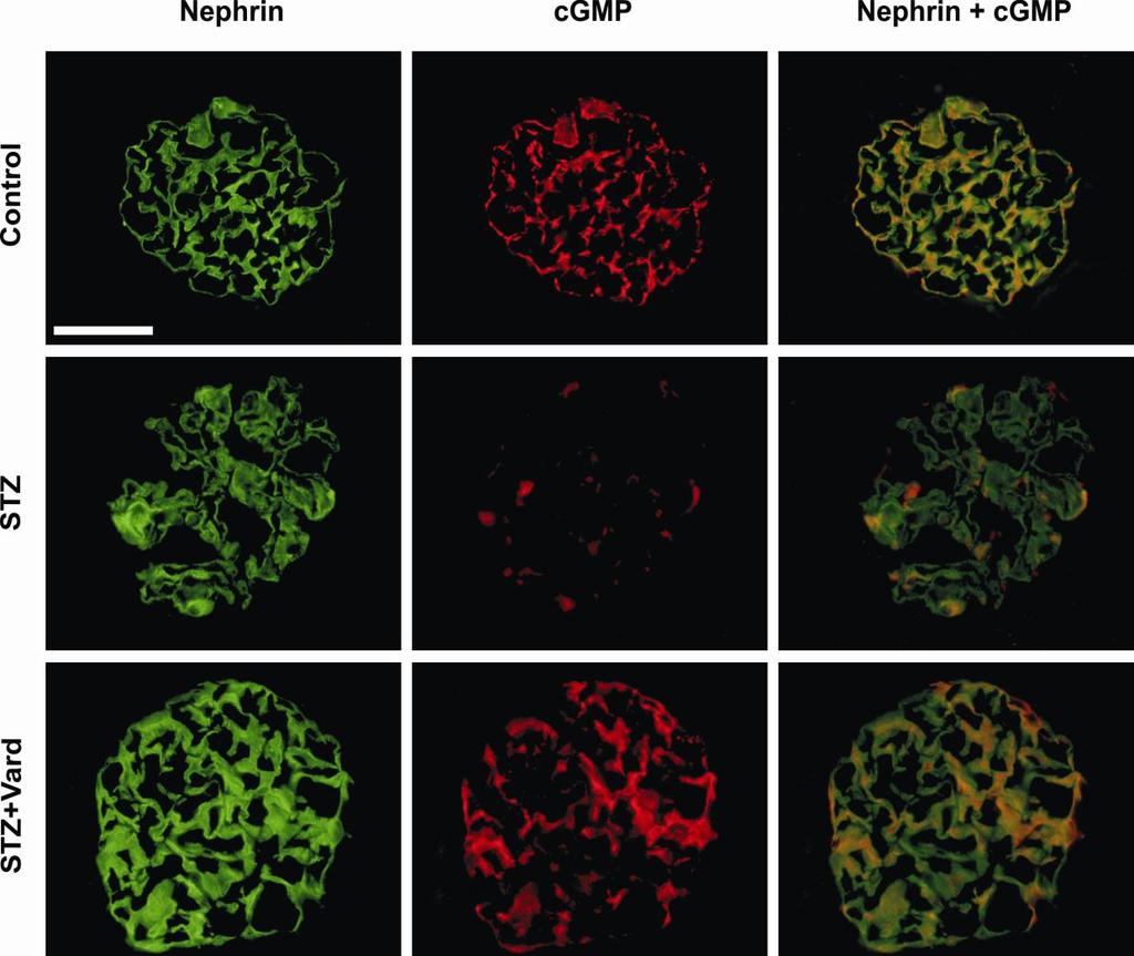 19. ábra Nefrin és cgmp lokalizációja kettős immunfluoreszcens festéssel. A nefrin festéssel a podociták ábrázolódnak a kontroll, az STZ és az STZ-Vard csoportokban (zöld szín, bal oszlop).