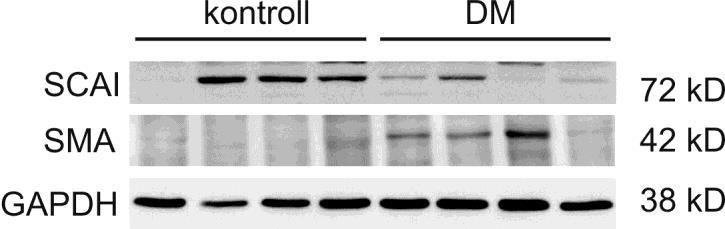 A kontroll csoportban erős SCAI és gyenge α-sma expresszió mutatkozott. Diabéteszben (DM) a SCAI expresszió szignifikánsan lecsökkent, míg az α-sma expressziója megnőtt. 25.