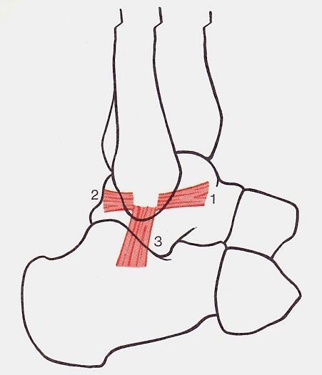 tibiotalaris anterior (3) - Pars tibionavicularis (1) b) Ligamentum laterale - Ligamentum talofibulare anterius (1) - Ligamentum