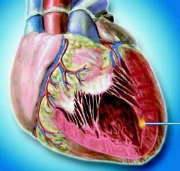 TRANSMYOCARDIALIS REVASCULARISATIO