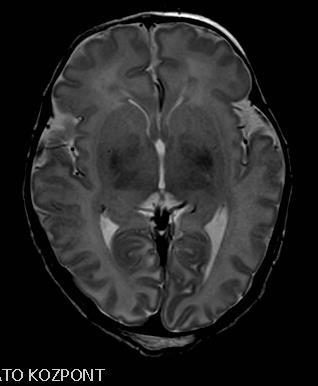 (polymicrogyria, lisencephalia,