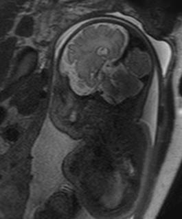 hypoplasias sinus