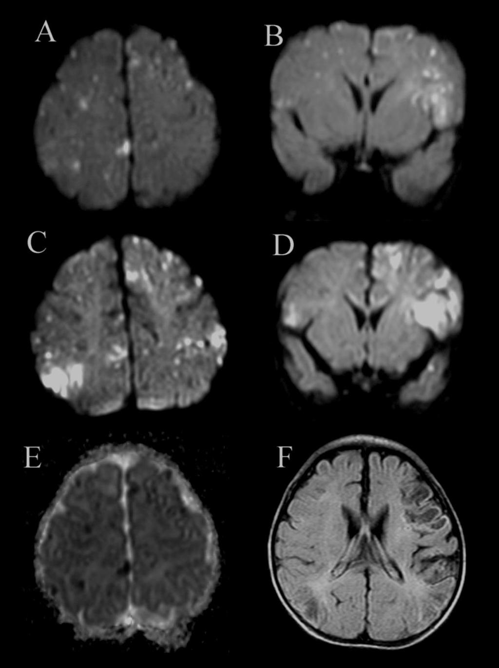 Congenital Infections Neonatal HSV 2