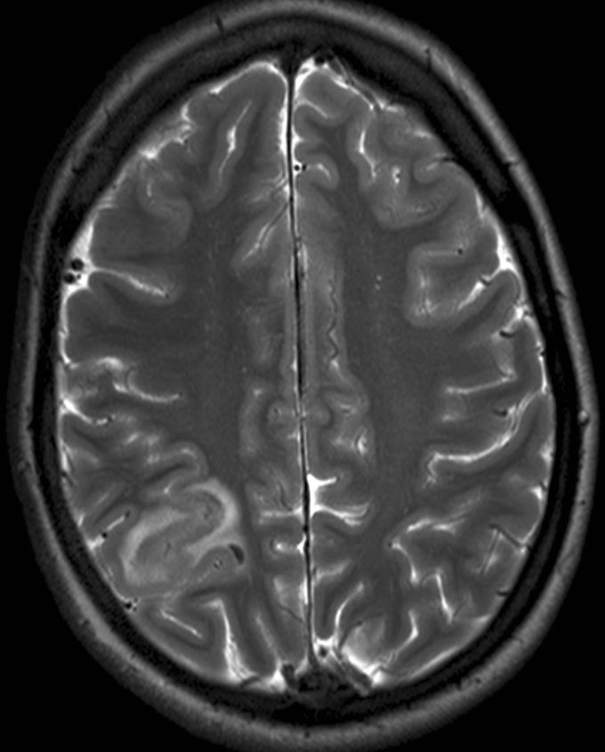 Meningitis