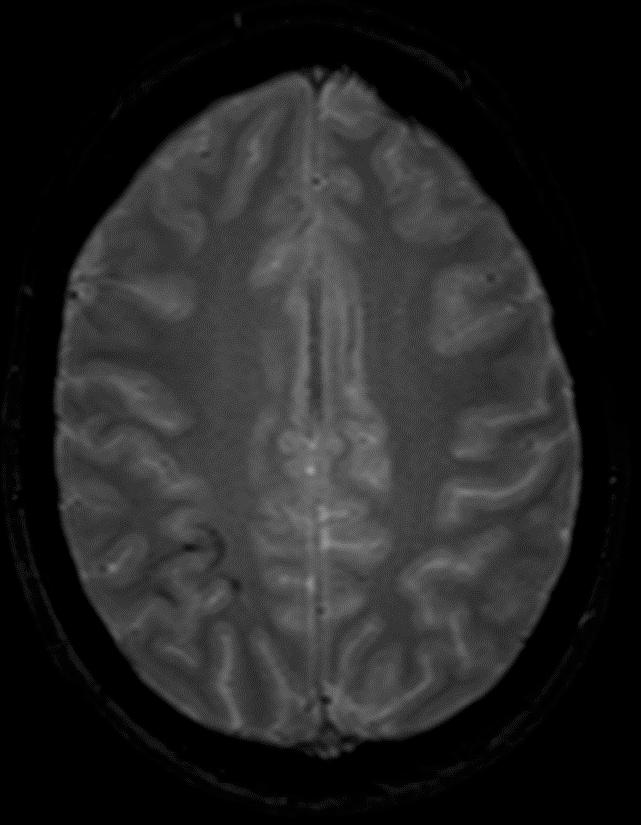 T1 Sagittal