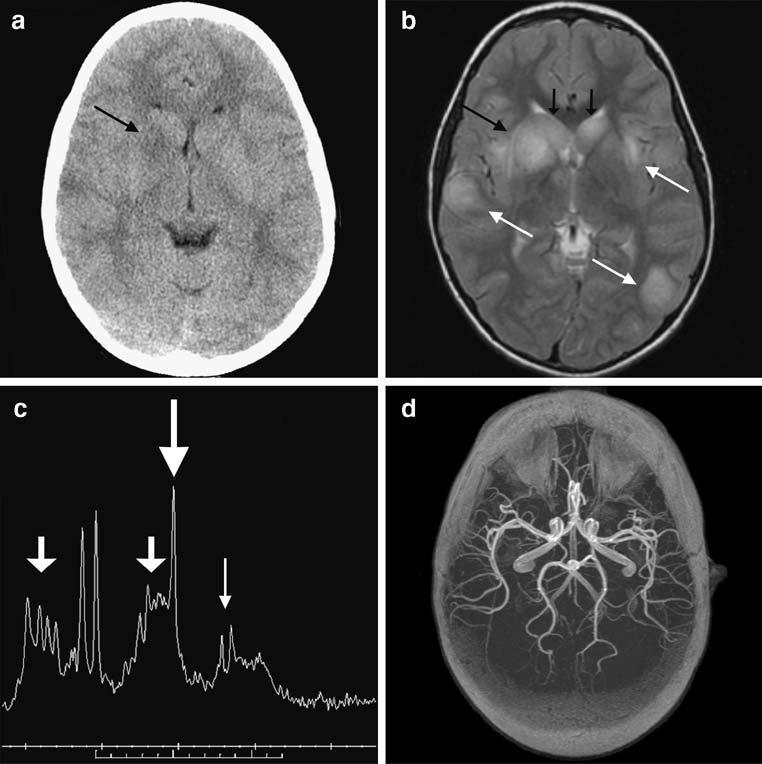 Encephalitis VZV