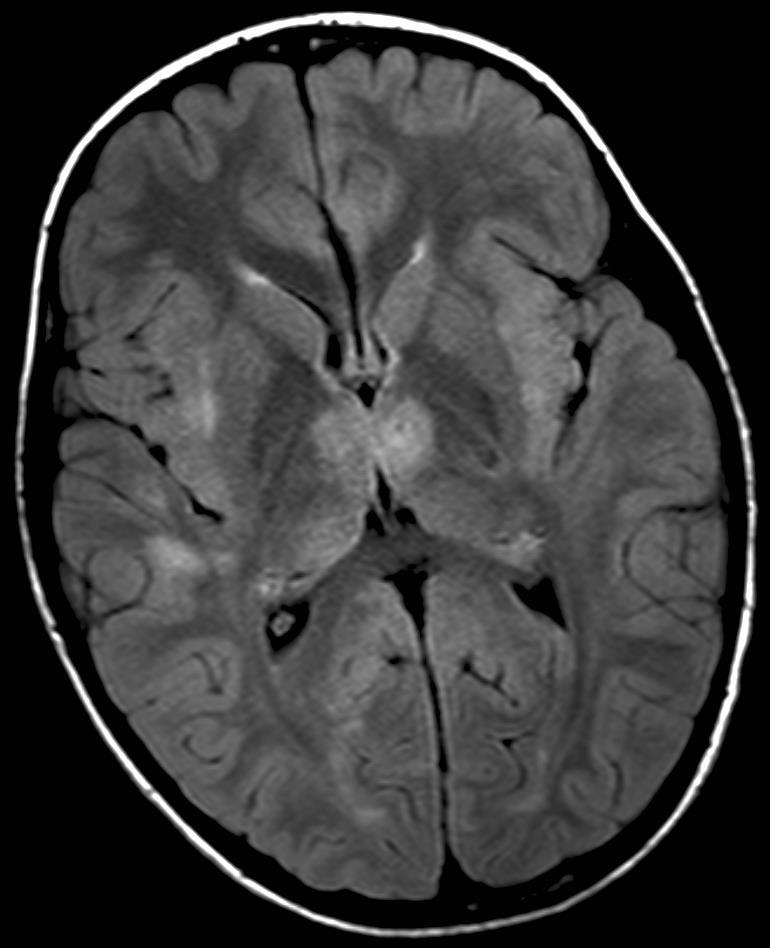 Encephalitis