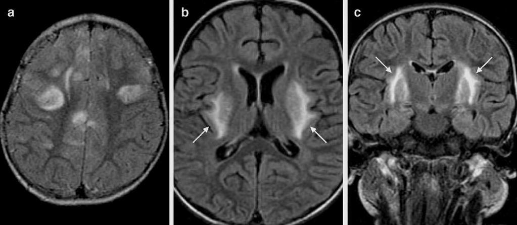 Encephalitis EBV encephalitis DWI FLAIR FLAIR Bilateral