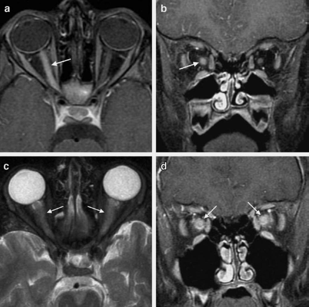 Encephalitis EBV Neuritis nervi optici