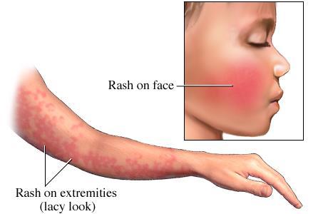 Human Parvovírus (B19V) Erythema infectiosum ( ötödik gyermekbetegség ) -3-5 éves gyermekek, fiatal felnőttek -Lappangási idő 4-14 nap -Cseppfertőzés, vérkészítménnyel, transzpalentárisan -Tünetes