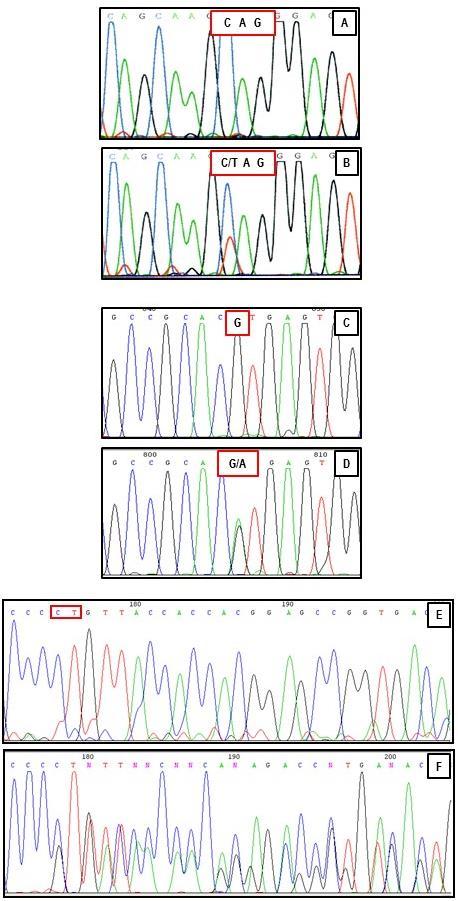 APPENDIX VII: A HCM-es betegcsoportban észlelt MYBPC3 génmutációk elektroferogramjai 34. ábra. A HCM-es betegcsoportban észlelt MYBPC3 génmutációk elektroferogramjai. Panel A: C>T tranzíció a 33-as exonban a H 16.