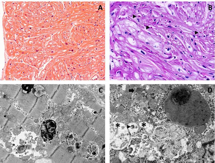 3. ábra. A LAMP2 vacuoláris cardiomyopathia kórszövettana. Panel A: Hypertrophizált cardiomyocyták myofiber disarray -el és sarcoplazmás vacuolizációval. Hematoxylin-eosin festés; nagyítás: x20.