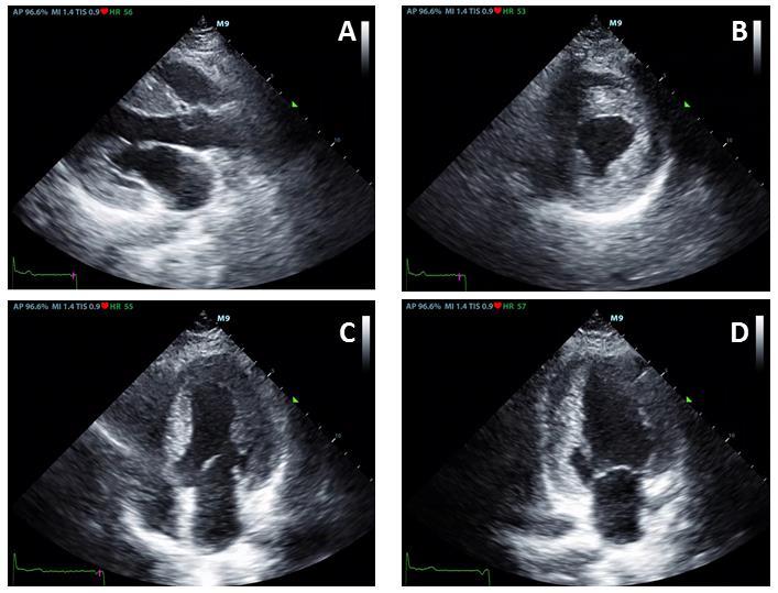6. ábra. A beteg transthoracalis echocardiographiás felvételei, non-obstruktív hypertrophiás cardiomyopathia képével, tágabb bal pitvarral, kifejezett koncentrikus bal és jobb kamra hypertrophiával.