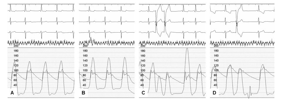 3.3. MEGFIGYELÉSEK PERKUTÁN TRANSZLUMINÁLIS SEPTALIS MYOCARDIUM ABLATIOVAL (PTSMA) KAPCSOLATBAN HYPERTROPHIÁS CARDIOMYOPATHIÁBAN 3.3.1.