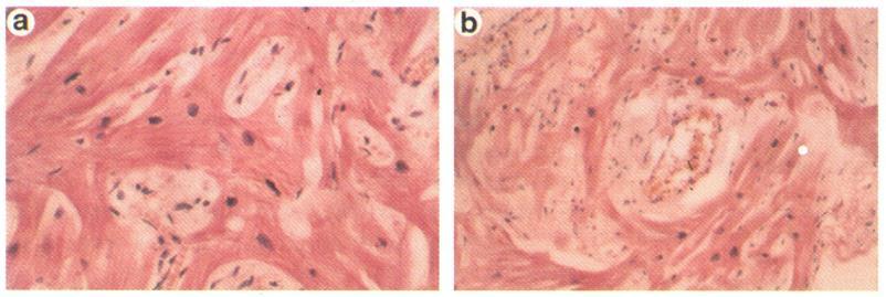 4. EREDMÉNYEK 4.1 ARRHYTHMOGÉN TÉNYEZŐK MORFOLÓGIAI ÉS KLINIKAI VIZSGÁLATA HYPERTROPHIÁS CARDIOMYOPATHIÁBAN 4.1.1. INTERCELLULÁRIS JUNKCIÓK ELTÉRÉSEINEK VIZSGÁLATA HYPERTROPHIÁS CARDIOMYOPATHIÁBAN 4.