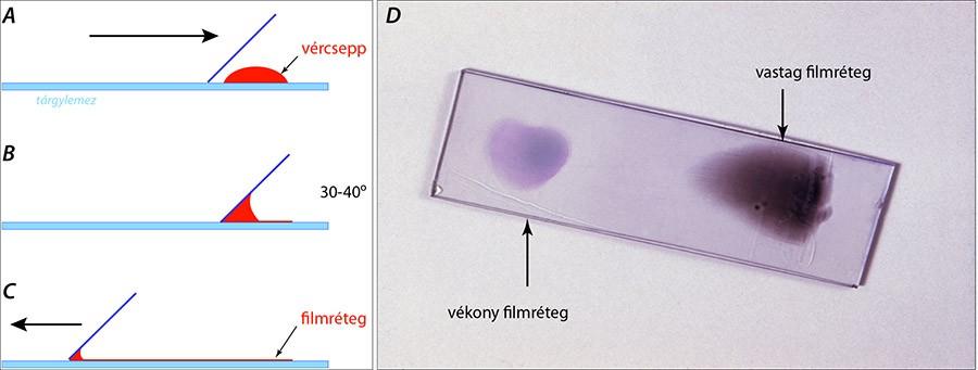 Vérkenet készítése forrás: http://ttktamop.elte.hu/onlinetananyagok/szovettani_es_sejtbiologiai_vizsgalomodszerek/ch02s02.html Vérkenet készítése (A C) és eredménye (D).