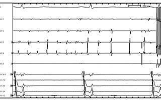 Cryoablation PVAC