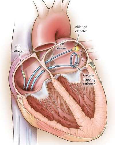 ablation catheter