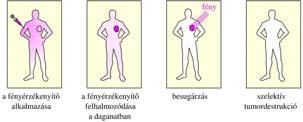 Fotokémiai mechanizmusok Terápiás alkalmazások: rákos sejtek elpusztítása fényérzékenyítőkön